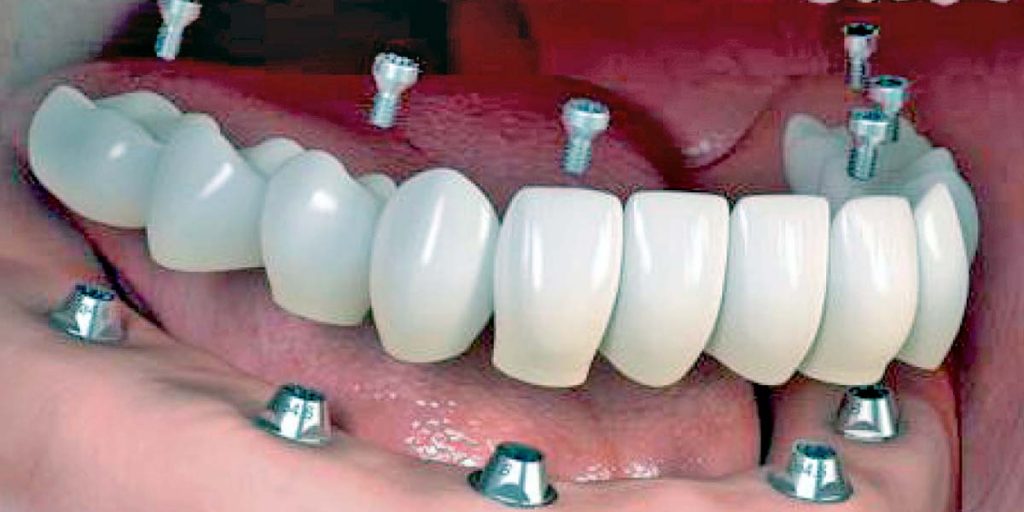 Egyfázisú implantátum alapú fogpótlás vs. kétfázisú implantátum