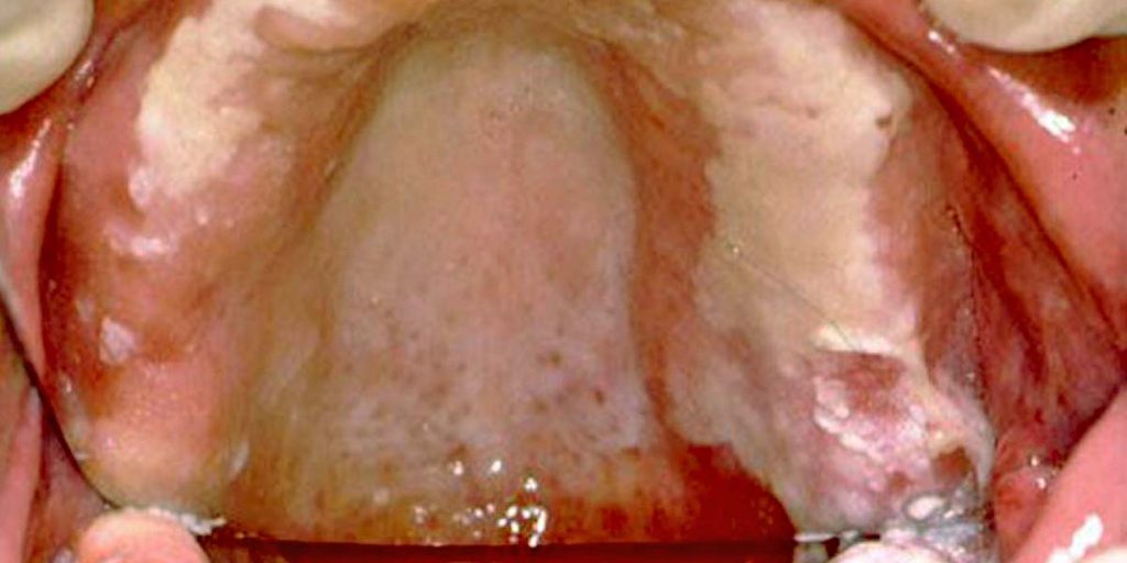 Fogászati fémallergia - Mit kell tudni róla?