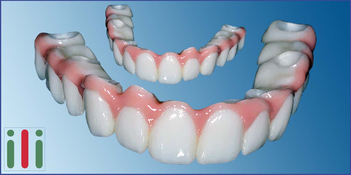 Benefits of immediate loading implants - Why should you choose it?