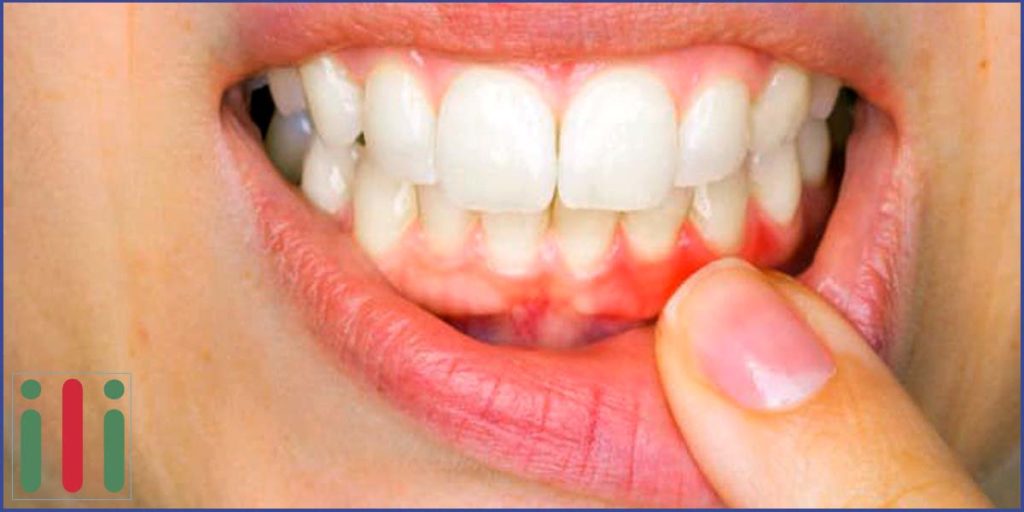 Fogágybetegség - Mi okozza, Lehetséges Szövődmények