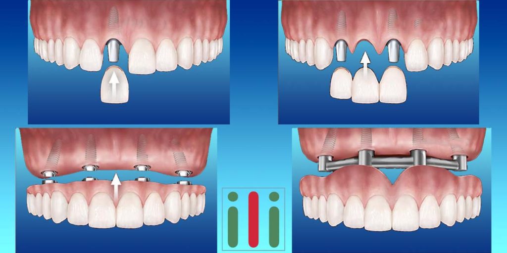 Az Implantátum Beültetés Négy Leggyakoribb Oka