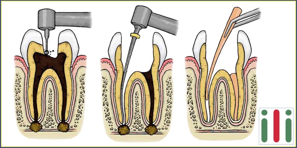 Gyökérkezelés, Hogyan Történik, Mikor Szükséges