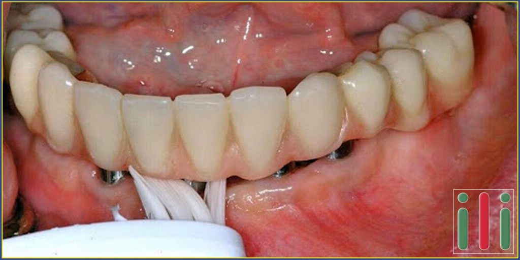 Fogbeültetés Utáni Helyes Fogápolás - Hasznos Tudnivalók