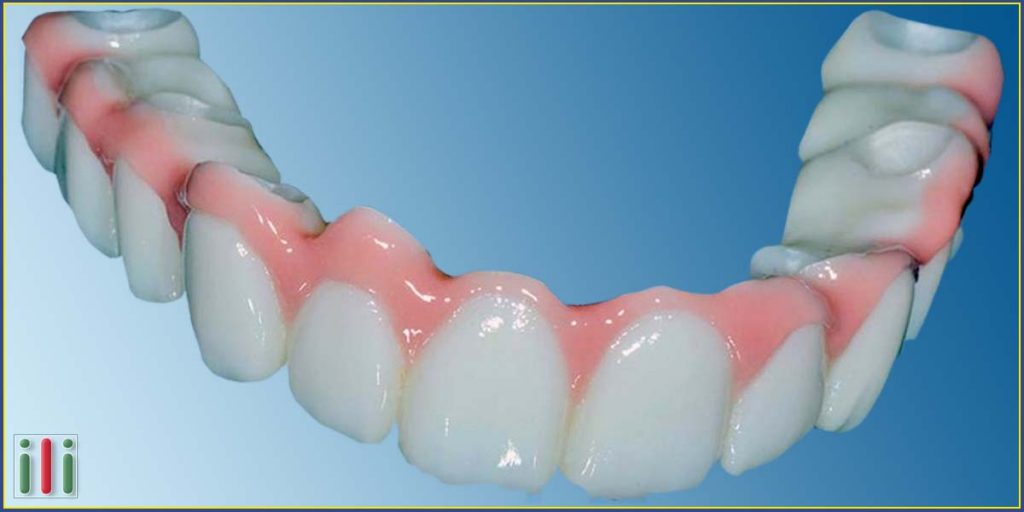 Miért előnyösebb az implantátum beültetés alapú fogpótlás?