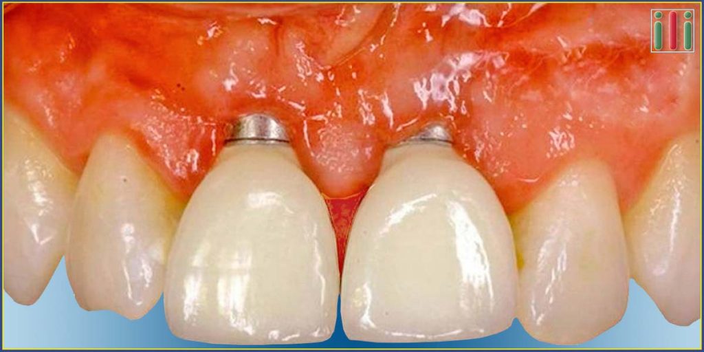 Lehetséges Probléma Kétfázisú Implantátummal - Megoldások