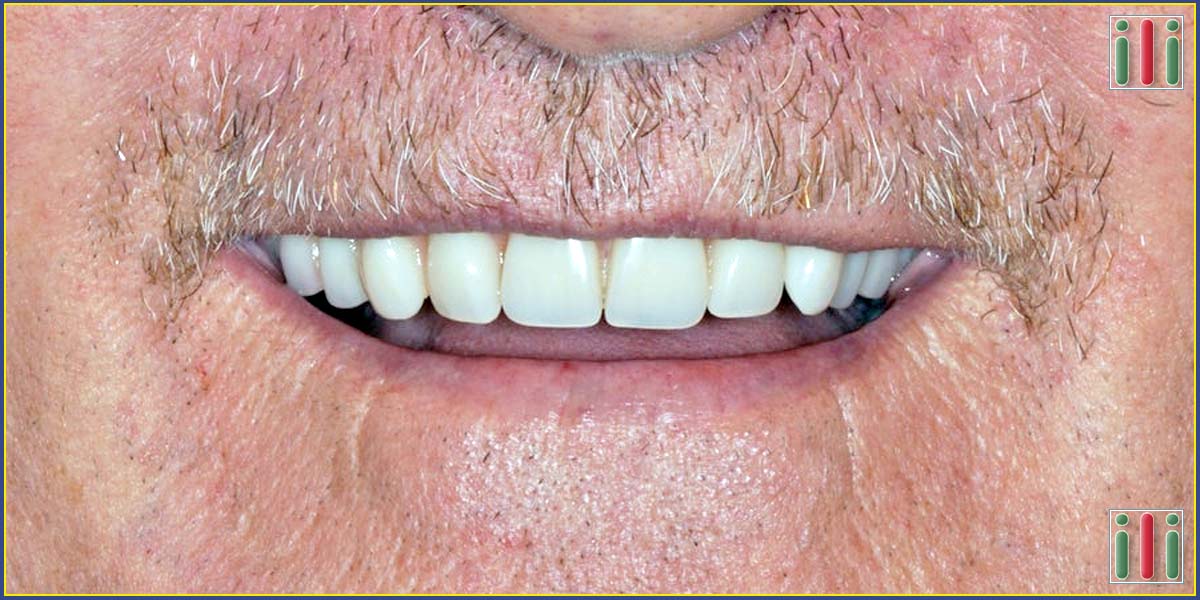 Dental implant prices, we work with favorable package price