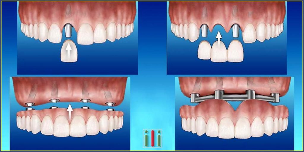 Dental implantation, the four most common areas the use of implants