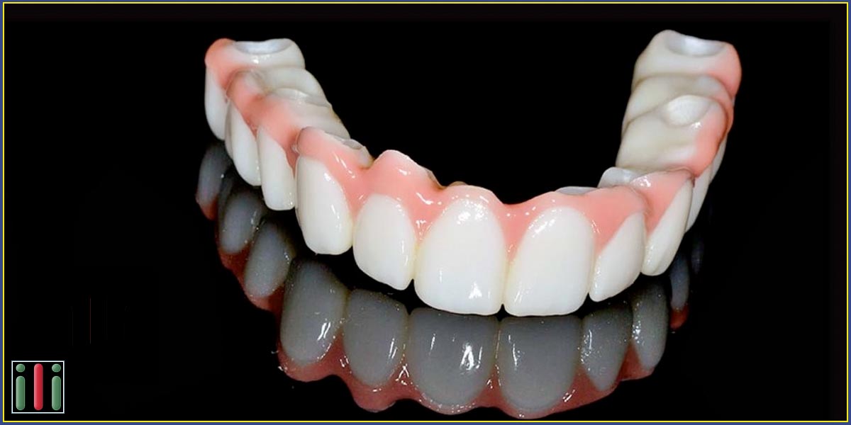 Why is dental implant-based denture the best solution to replace missing teeth?