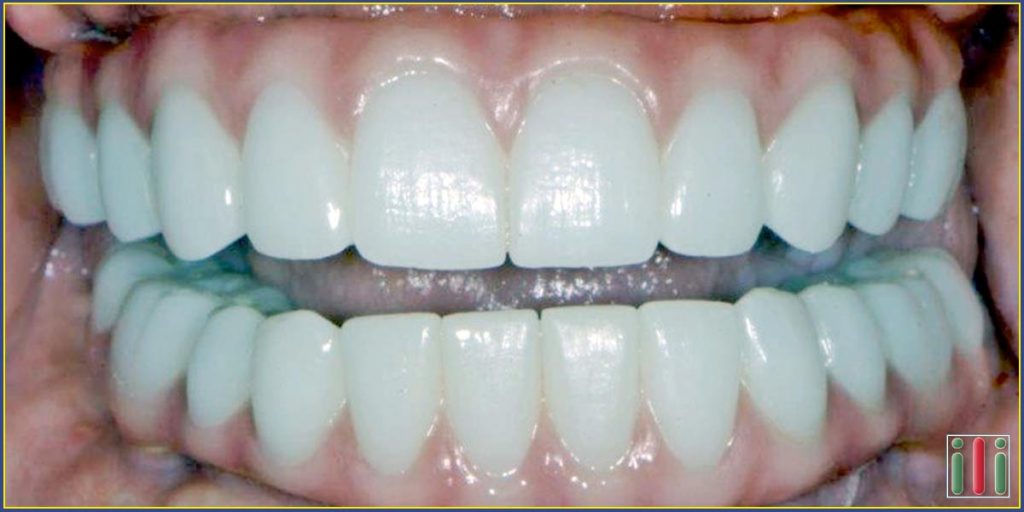 One-phase immediate loading implant frequently asked questions