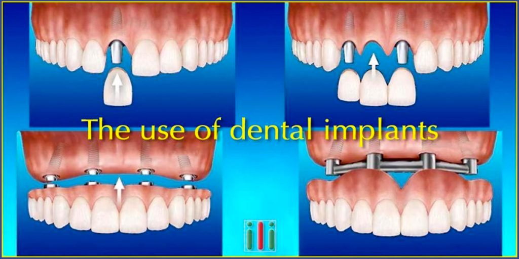 One-phase dental implantation - The 4 most common use