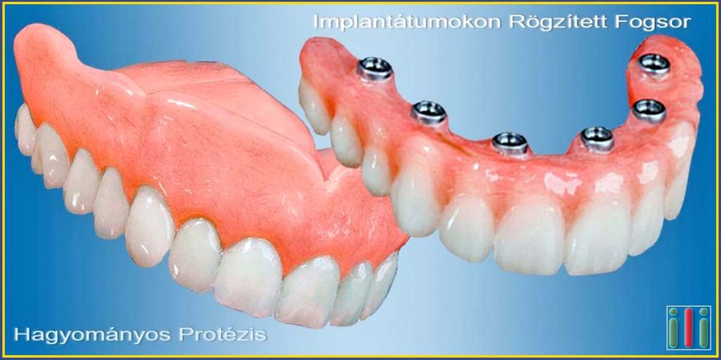 Implantátum alapú fogpótlás vs. Hagyományos módszer