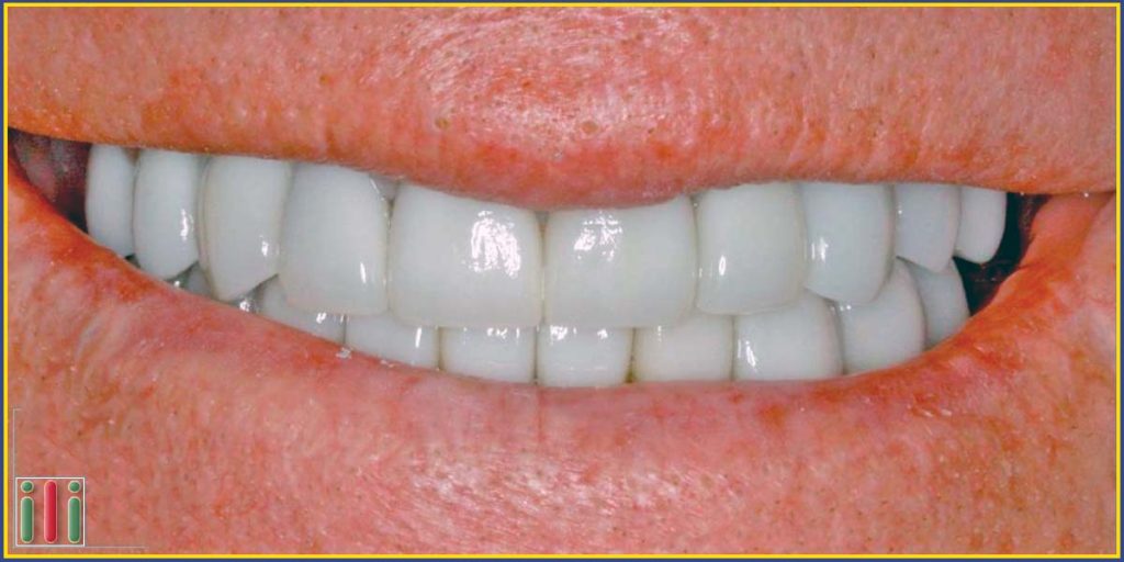 Szájrehabilitáció egyfázisú implantátummal előnyei és hátrányai