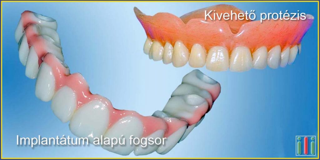 Egyfázisú fogimplantátum beültetés vs. kivehető protézis