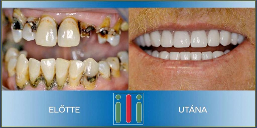 Teljes fogsor egyfázisú implantátummal - Fogpótlás felsőfokon