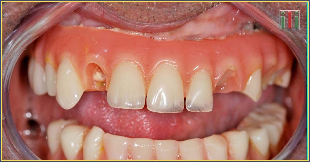 Lehetséges problémák az egyfázisú implantátummal és a kétfázisú implantátummal