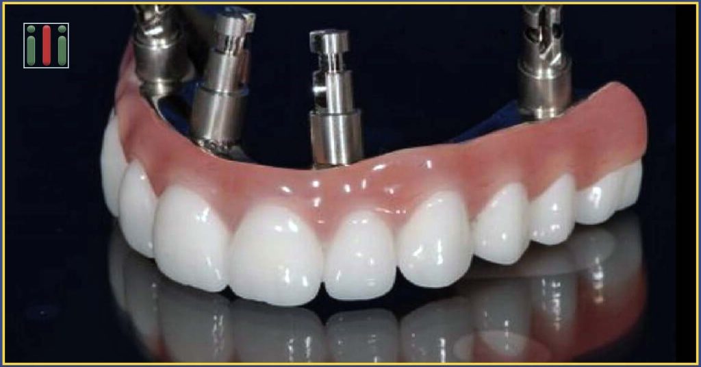 Dental Implant-Based Oral Rehabilitation with Sedation