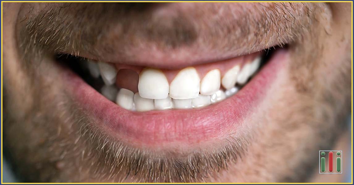 A foghiány egészségügyi és esztétikai hátrányai