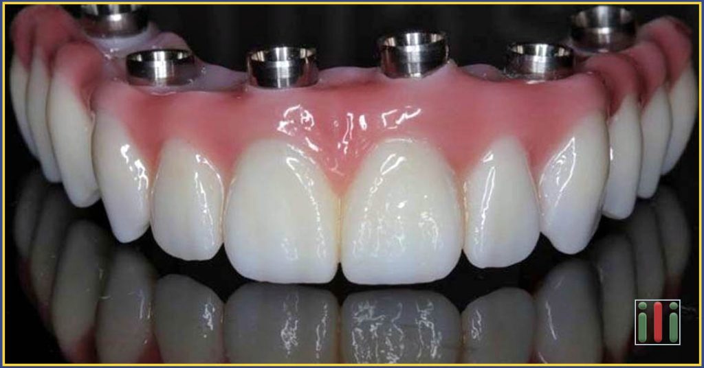 One-phase Implant Placement Cost Comparison
