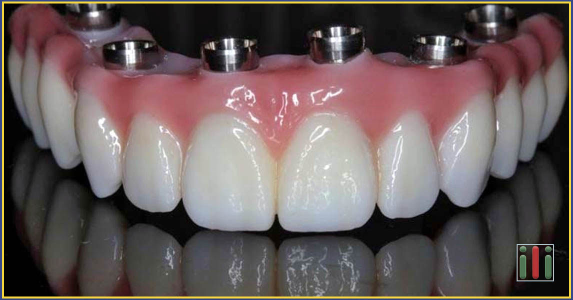 One-phase Implant Placement Cost Comparison