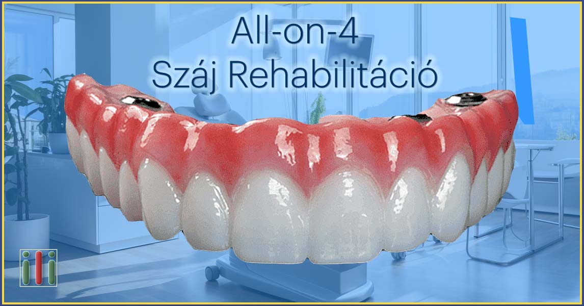All-on-4 száj rehabilitáció - Fogpótlás implantátummal
