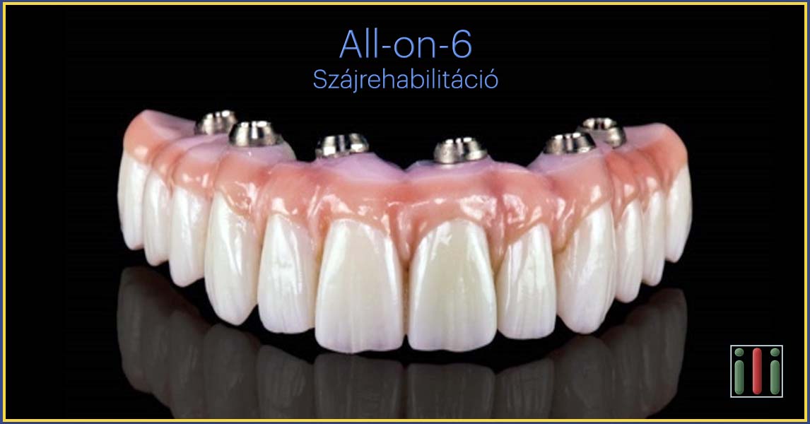 All-on-6 szájrehabilitáció - Fogpótlás implantátummal