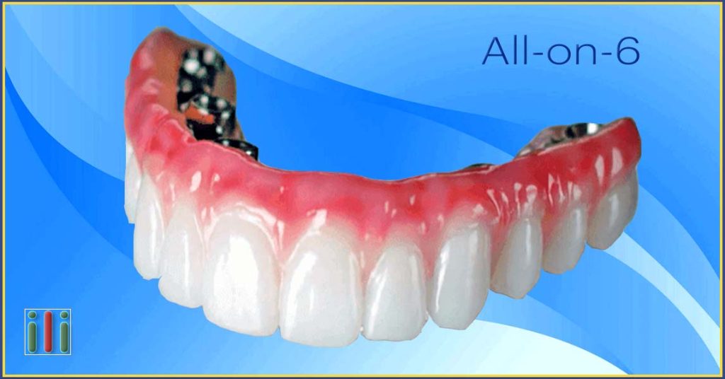 All-on-6 oral rehabilitation - Tooth replacement with implants