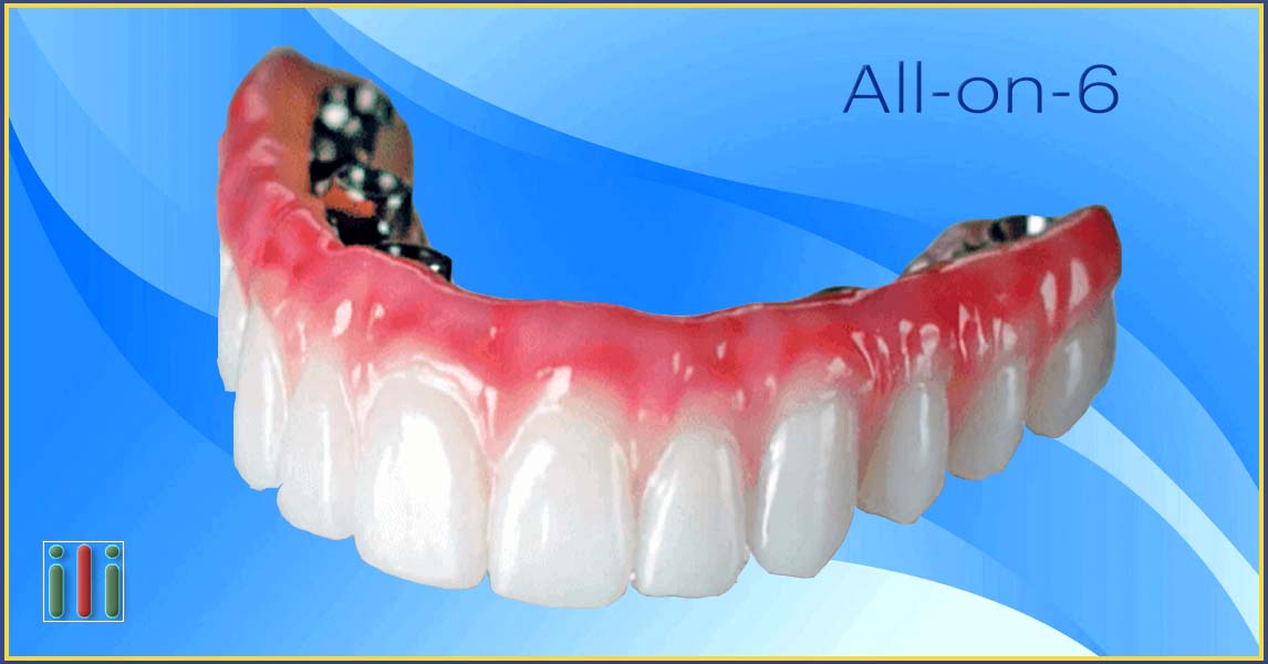 All-on-6 oral rehabilitation - Tooth replacement with implants