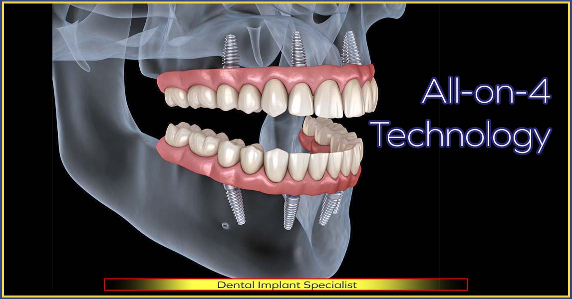 All-On-4 dentures, with four implants