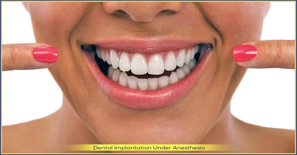 All-on-4 complete dentures, pros and cons