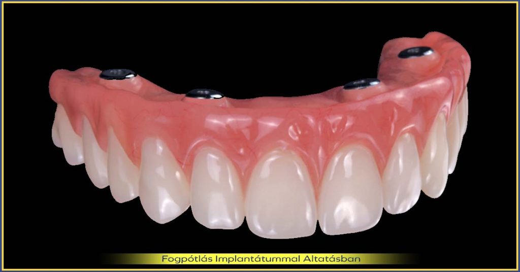 All-on-4 szájrehabilitáció előnyei és hátrányai