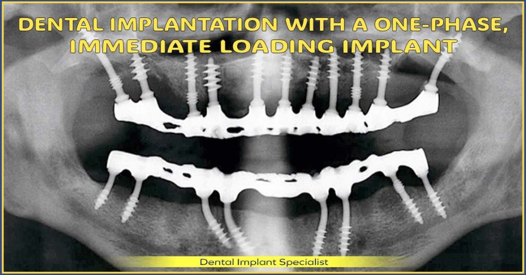 Dental implantation with a one-phase, immediate loading implants – new, fixed denture in up to 7 working days