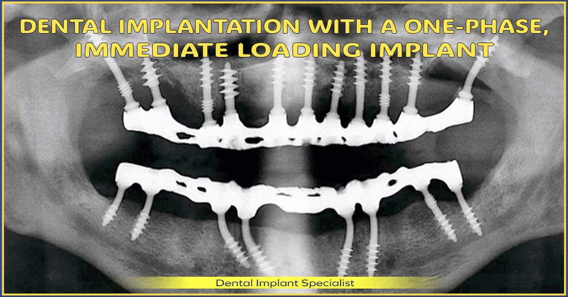 Dental implantation with a one-phase, immediate loading implants – new, fixed denture in up to 7 working days