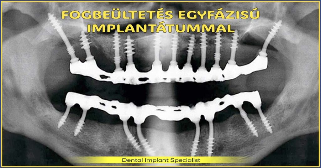 Fogbeültetés egyfázisú, azonnal terhelhető implantátummal – új, fix fogsor akár 7 munkanap alatt