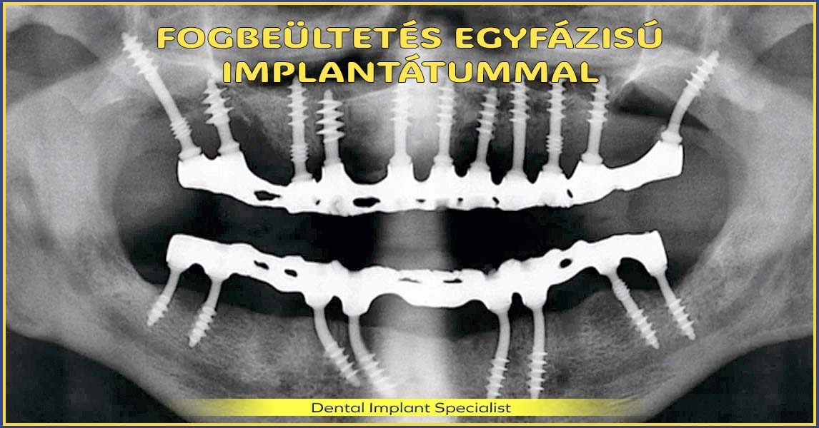 Fogbeültetés egyfázisú, azonnal terhelhető implantátummal – új, fix fogsor akár 7 munkanap alatt