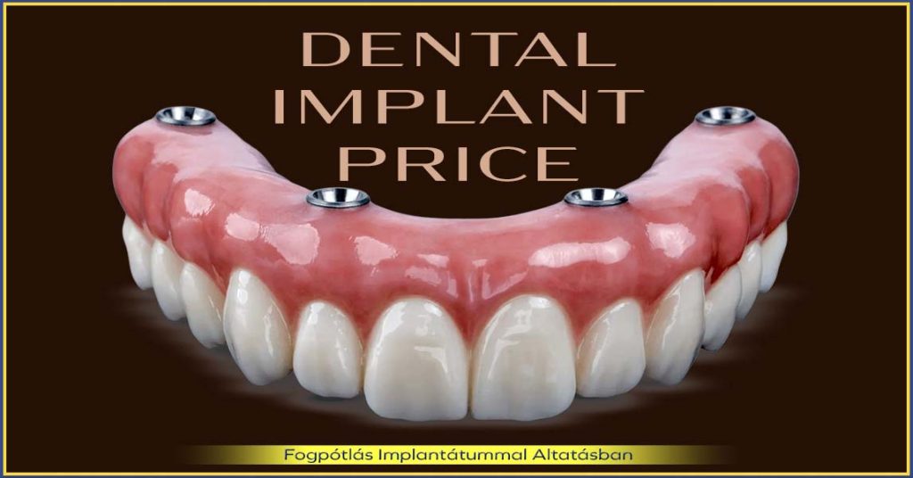 Dental Implant price – Is it worth investing in quality and safety
